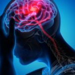 راهکارهای پیشگیری از سکته مغزی