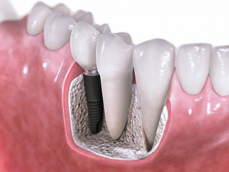 آیا واقعاً کاشت ایمپلنت برای افراد مبتلا به پوکی استخوان ایمن است؟