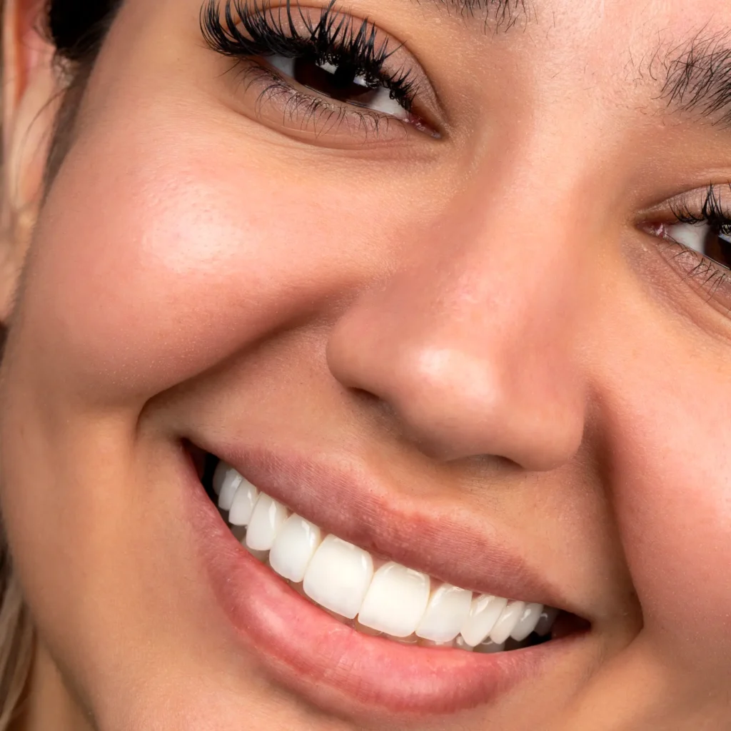 راز لبخندی جاودان با اصلاح طرح لبخند