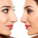 نشانه های عفونت پس از عمل بینی