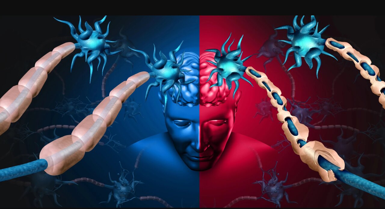 یافته‌های جدید درباره ام‌اس