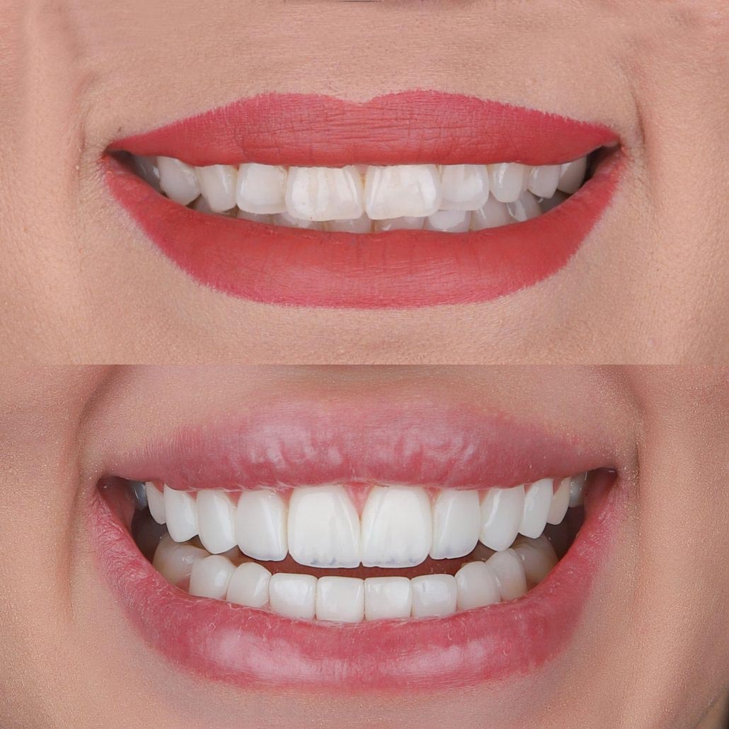 مزایای کامپوزیت دندان چیست؟ (راهنمای سریع برای انتخاب بهترین روش زیبایی)